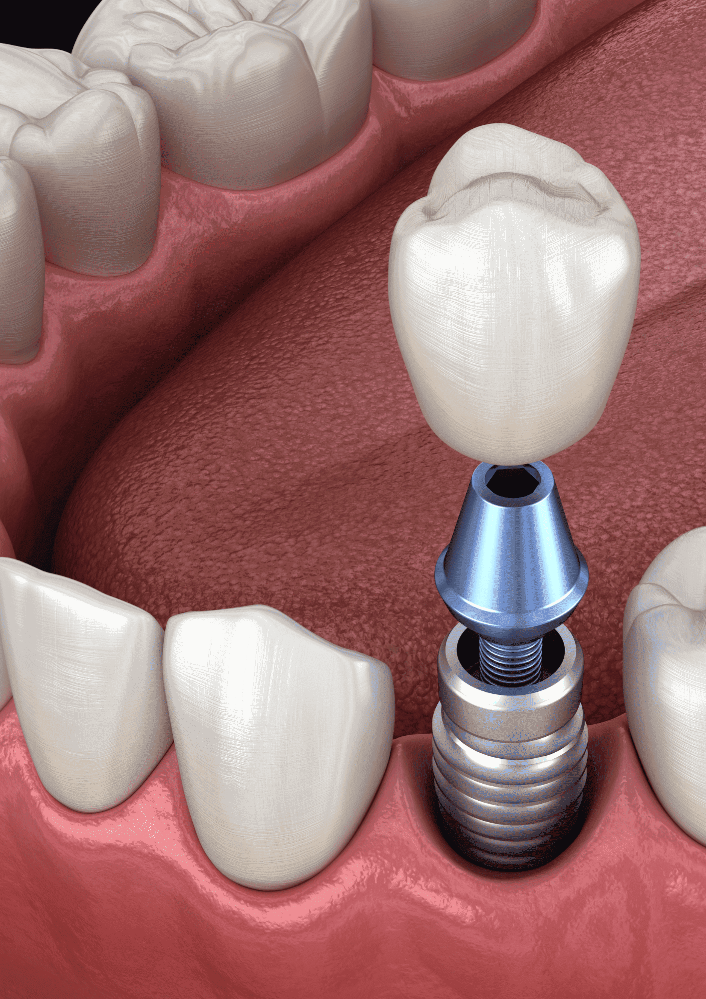 Single Dental Implants