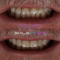 SmileFast Before and After Teeth Comparison