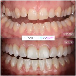 SmileFast Before and After Teeth Comparison