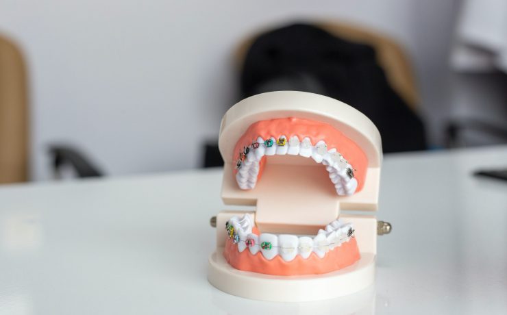 Model of Teeth With Different Coloured Braces