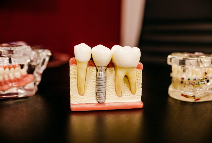 Model of 3 Teeth